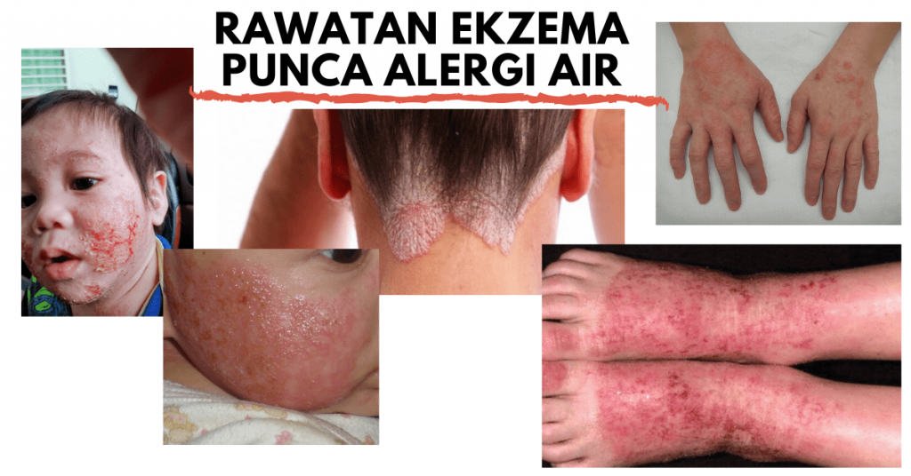 Rawatan Ekzema Punca Alergi Air oleh Hariz Coway
